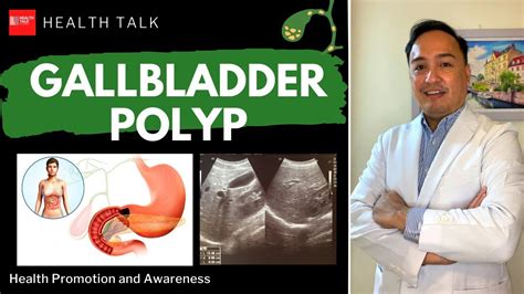 Gallbladder Polyp: Symptoms, Causes, Diagnosis, Treatment & Prevention ...