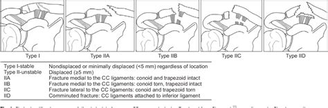 Clavicle Fracture Classification