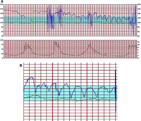 Sawtooth fetal heart rate pattern due to in utero fetal central nervous system injury | Obgyn Key