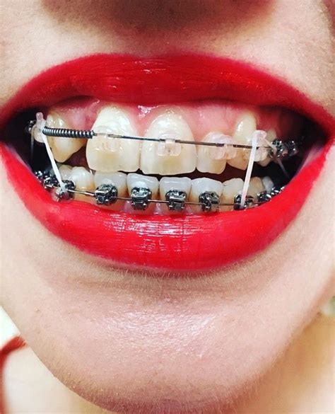 #braces #metalbraces #girlswithbraces #elastics #springs #clearbraces | Брекеты, Зубы