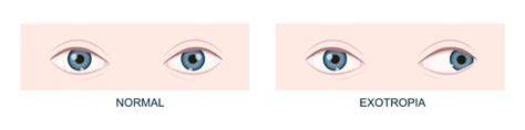 Exotropia (Eye Misalignment): Causes, Types and Treatment