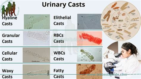 Urinary Casts - A Comprehensive Guide | Lab Tests Guide