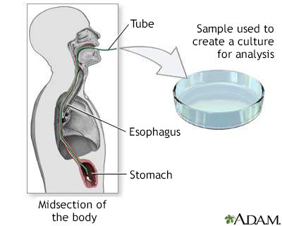 Gastric tissue biopsy and culture Information | Mount Sinai - New York