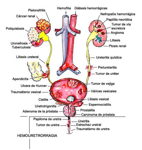 Hematuria. Causes, symptoms, treatment Hematuria