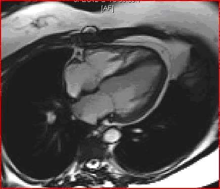 Cardiac MR Viability Imaging Exam | Radiology Associates of Clearwater