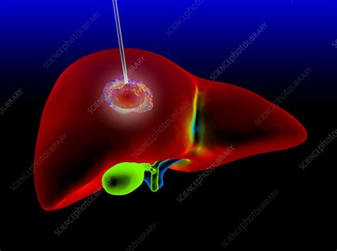 Liver cancer thermal ablation, illustration - Stock Image - C047/1678 - Science Photo Library