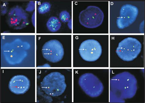 FISH signal patterns of clinically used FISH probes. (A) A HER-2 DNA ...