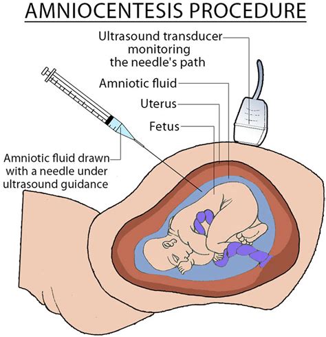 Amniocentesis - Test Accuracy, Risks, Complications