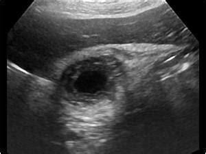 Abdomen and retroperitoneum | 1.2 Gallbladder and bile ducts : Case 1.2.10 Gallbladder ...