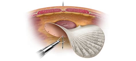 How is the use of Mesh Helpful During a Hernia Surgery? - Neoalta Speciality Clinic