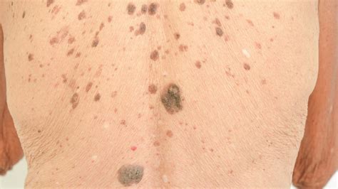 Age & Liver Spots: Symptoms, Causes, & Treatment - Toronto Dermatology Centre