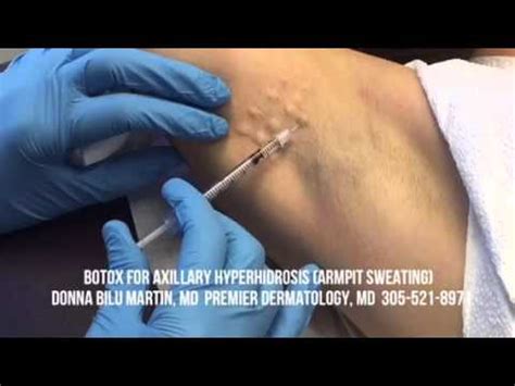 Botox for Axillary Hyperhidrosis at Premier Dermatology, MD | Photos and Videos | Video Gallery