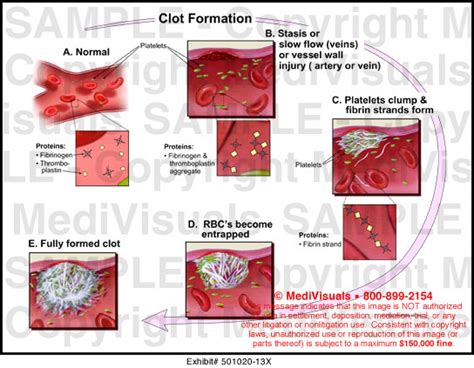 Prothrombin 20210A Mutation | SiOWfa15: Science in Our World: Certainty ...