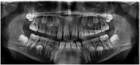 Morphological Variations Of Mandibular Sigmoid Notch In Children Aged 4-14 Years | Contemporary ...