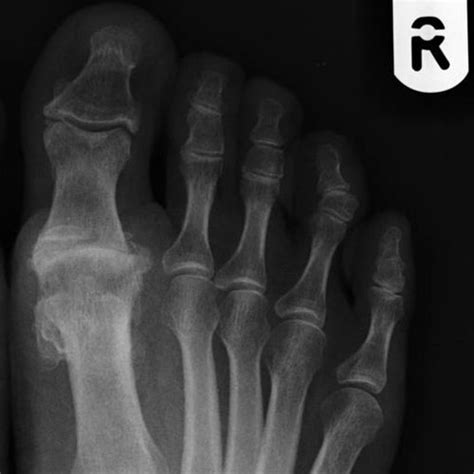 1st Metatarso-phalangeal (MTP) joint osteoarthritis ( Big toe arthritis)