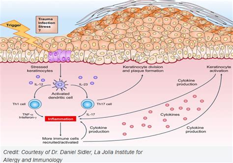 HOW IT WORKS – Comizla Psoriasis Cream