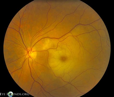 Cilioretinal Artery Occlusion