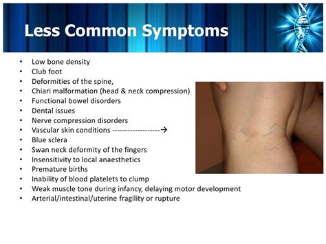 Ehlers-Danlos Syndrome & Hypermobility | Ehlers danlos syndrome ...