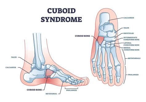 6 Best Exercises To Alleviate Pain From Cuboid Syndrome