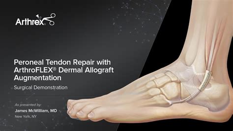 Arthrex - Peroneal Tendon Repair with ArthroFLEX® Dermal Allograft Augmentation