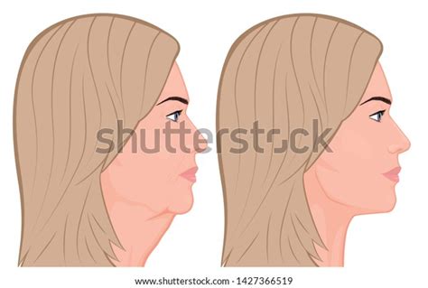 Vector Illustration Female Face Before After Stock Vector (Royalty Free) 1427366519 | Shutterstock