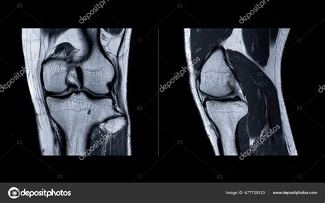 Magnetic Resonance Imaging Knee Joint Mri Knee Sagittal Detect Tear ...