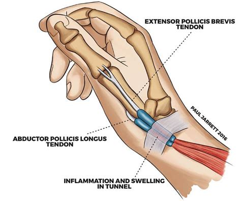 De Quervain Tenosynovitis: Symptoms, Causes & Treatment Plan