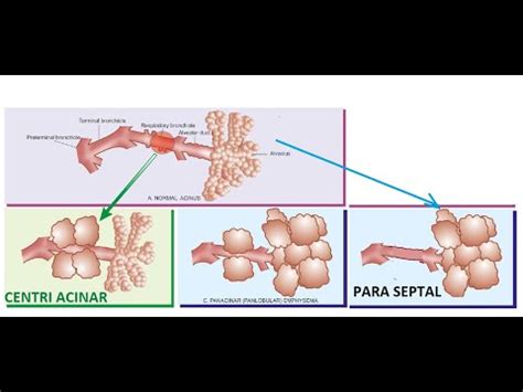 Pathology 459 c Emphysema Types CentriAcinar CentriLobular PanAcinar ...