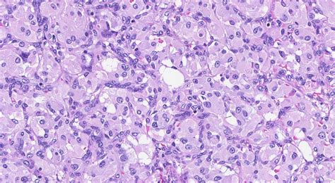 Paraganglioma | Atlas of Pathology