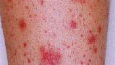 Vasculitis Associated with Biologic Use | 1RheumNow