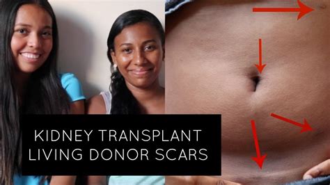 Kidney Transplant Donor Scar - YouTube