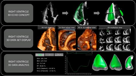 3D echocardiographic assessment of the RV. (Upper) Standard 2D ...