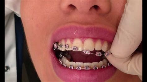 How Braces are removed! - YouTube