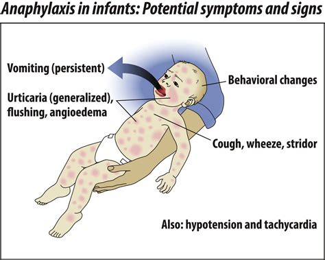 Anaphylaxis: Unique aspects of clinical diagnosis and management in ...