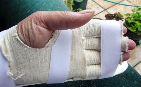 Hand Splints May Ease Pain for People Suffering Degenerative Arthritis ...