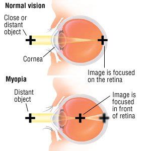 Nearsightedness (Myopia) Guide: Causes, Symptoms and Treatment Options