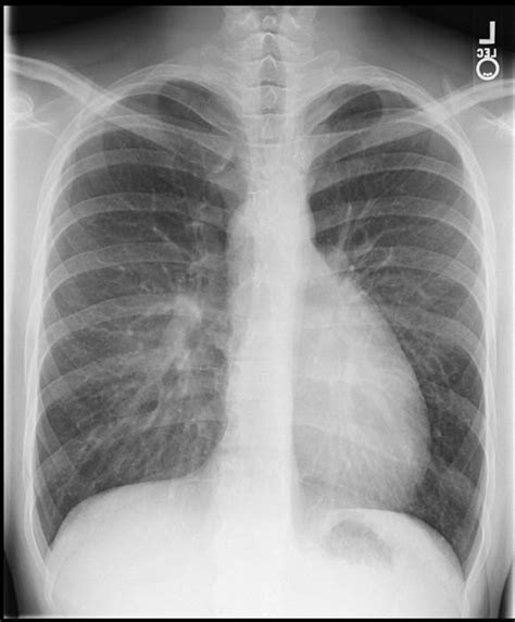 Dextro-transposition of the great arteries chest X ray - wikidoc