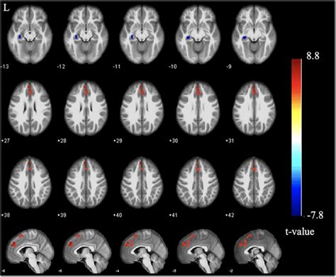 ALFF differences between groups. Significantly increased (red) and ...