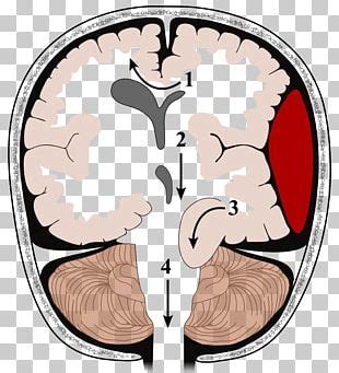 Brain Herniation Intracranial Pressure Traumatic Brain Injury Cerebellar Tonsil PNG, Clipart ...