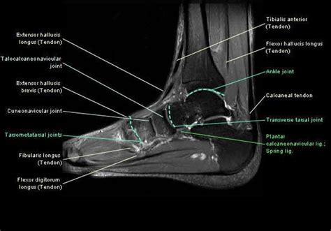 MRI: ankle | Mri study guide, Mri study, Magnetic resonance imaging