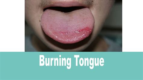 What Causes Your Tongue And Lips To Burn | Lipstutorial.org