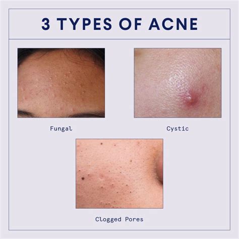 Types of acne: blackheads, whiteheads, fungal, cysts + more Mens Skin Care, Skin Care Acne ...