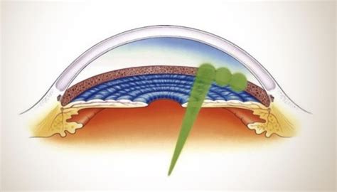 SLT – Gentle Laser Glaucoma Treatment — Wollongong Eye Doctor | Ophthalmologist Dr Steven Yun ...