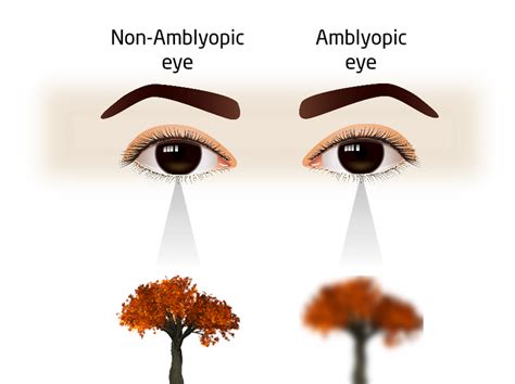 Amblyopia