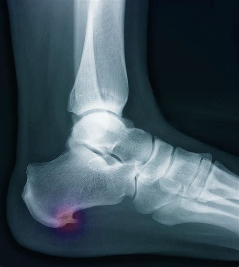 Heel Bone Spur Photograph by Zephyr/science Photo Library - Pixels