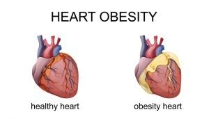 Obesity and heart attack | doctorvisit