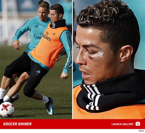 Cristiano Ronaldo Sports Black Eye After Bloody Collision | TMZ.com