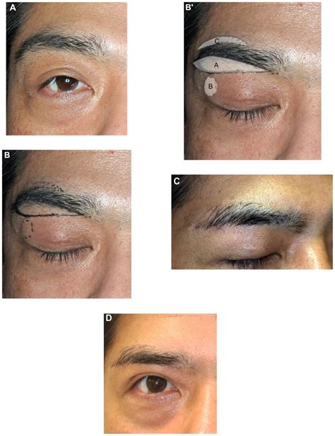 Case 1. (A) A 50-year-old man with moderate bilateral dermatochalasis.... | Download Scientific ...