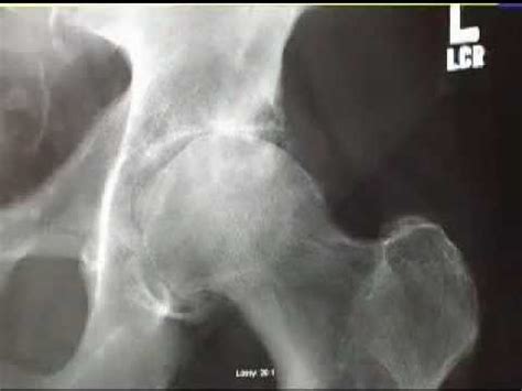 Diagnosing an Arthritic Hip Joint - YouTube