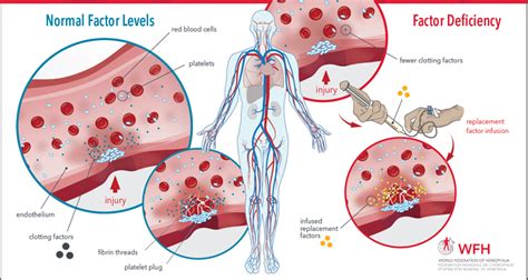 Factor Replacement Therapy Schematic - eLearning Platform